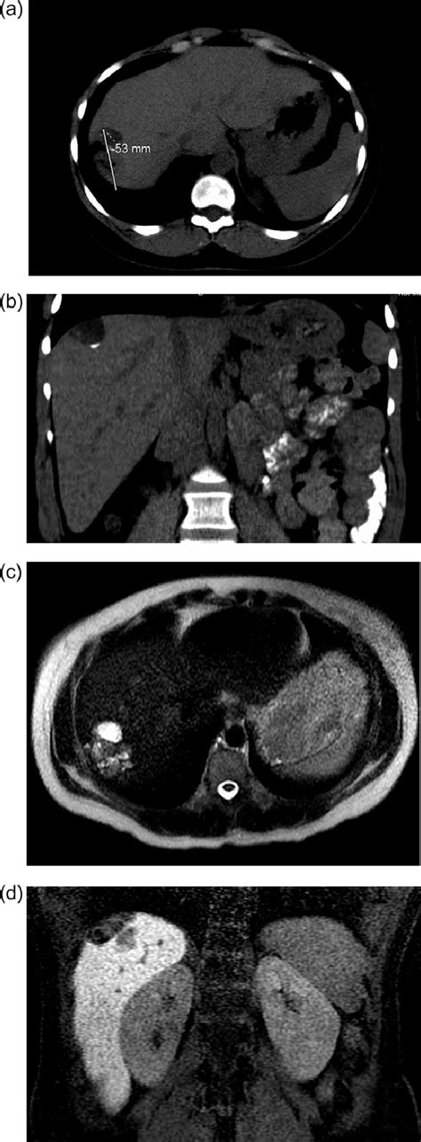 A And B Ct Abdomen And Pelvis Without Iv Contrast Demonstrating Tumor