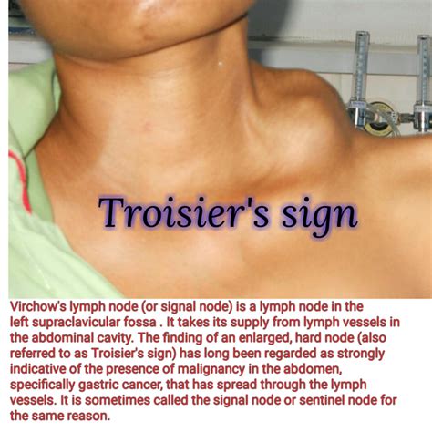 Troisier S Sign Enlargement Of The Virchow S Lymph Nodes MEDizzy