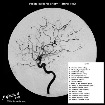 Middle Cerebral Artery Branches Radiology Case Radiopaedia Org