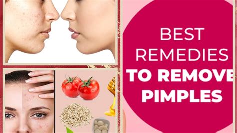 How To Get Rid Of Pimples Best Home Remedies To Remove Pimples Youtube