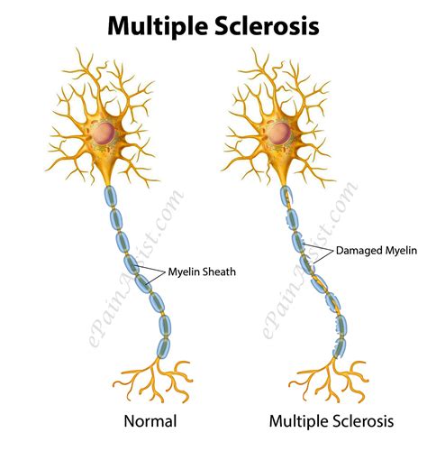 The disorder is characterized by destruction of the myelin. Multiple Sclerosis or Disseminated Sclerosis|Types|Risk ...