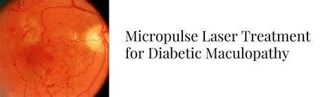 Micropulse Retinal Laser Therapy For Diabetic Retinopathy Sinclair