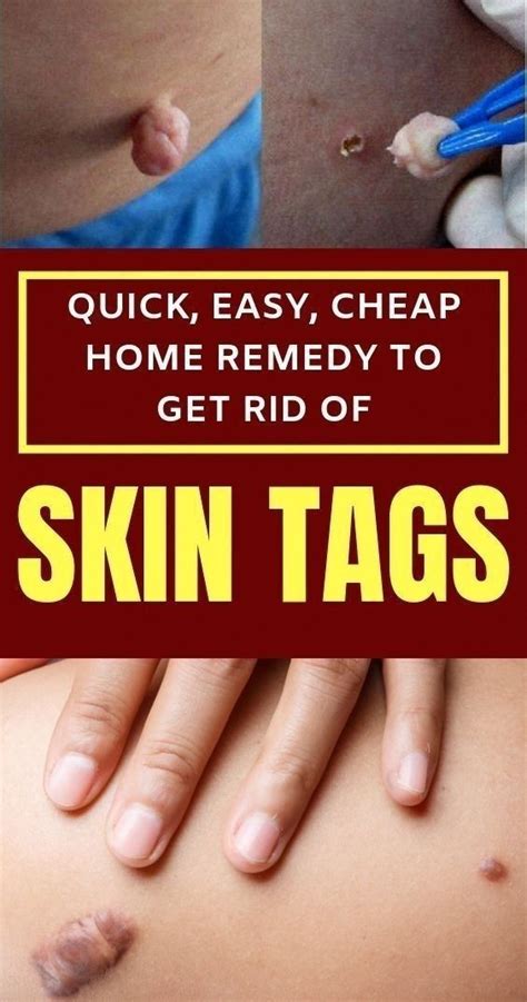 quick easy cheap home remedy to get rid of skin tags in 2022 home remedies for skin remove