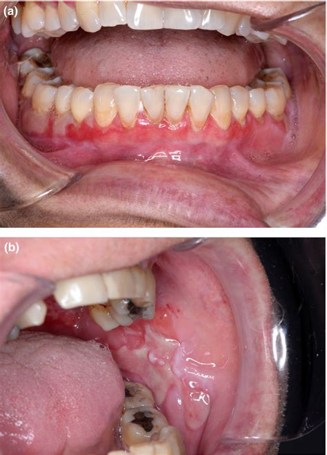 Mucous Membrane Pemphigoid And Oral Blistering Diseases Carey 2019