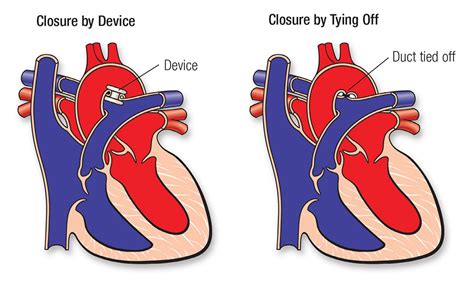 Patent Ductus Arteriosus Pda American Heart Association