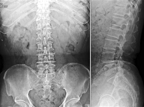 Lumbar Spine Radiograph Anatomy