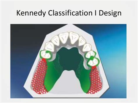 Designing A Removable Partial Denture Kennedys Classification