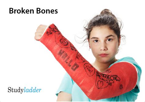 Broken Bones 8slides Studyladder Interactive Learning Games