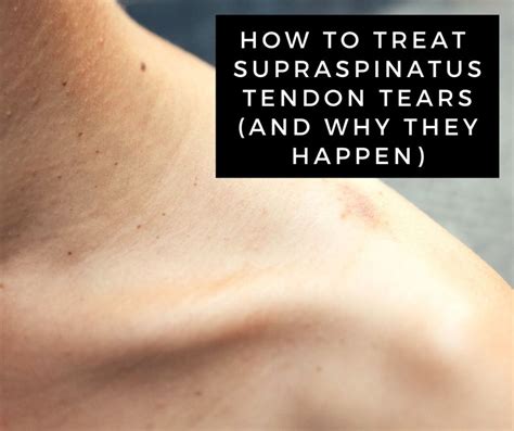 A Guide To Supraspinatus Tendon Tears Rotator Cuff Injury Tendon