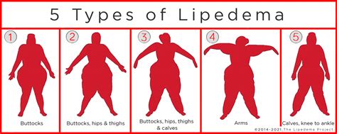 Welcome Back And Introduction To Lipedema Lipedema Simplified