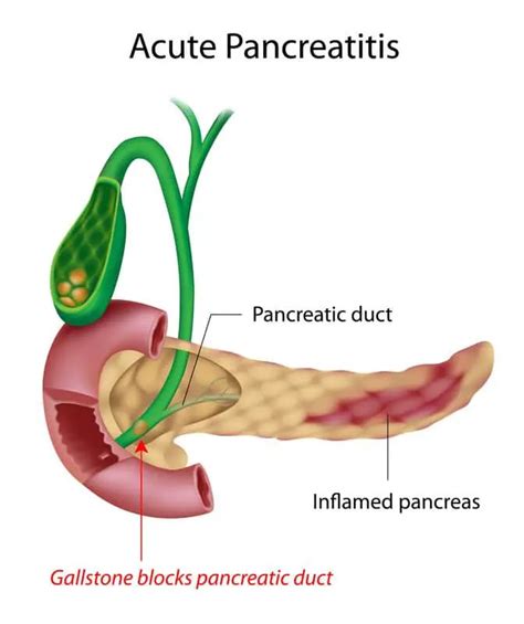Pancreatitis Pathophysiology Podcast And Nursing Care Plan
