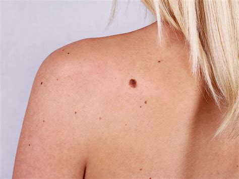 Skin Cancer Warning Signs What Skin Cancer Looks Like Vrogue Co