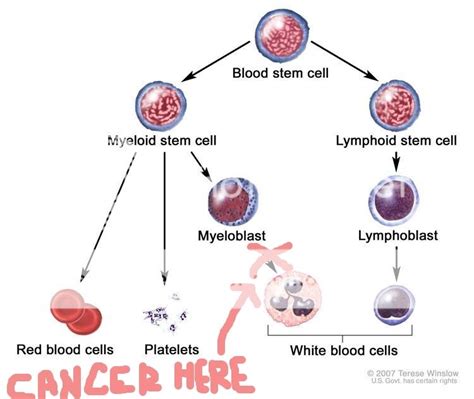 Acute Myeloid Leukemia — Pathophysiology
