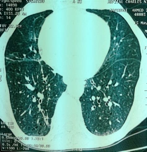 Figure 5 Ct Scan Showing Nodular Lung Lesions Histiocytosis With