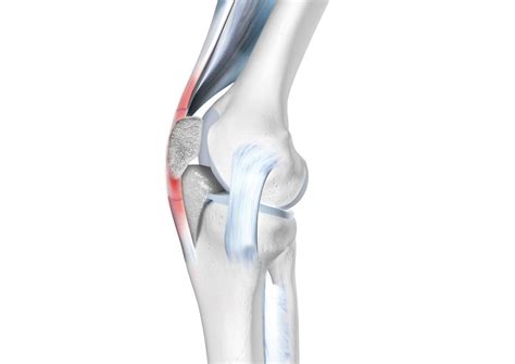 Patellar Tendonitis Causes Symptoms And Treatment Bauerfeind Anz