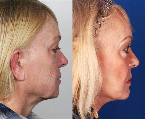 Contour Dermatology Mini Facelift Before And After
