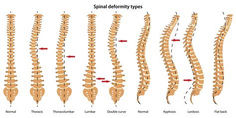 Your Posture And The Shape Of Your Spine The Buxton Osteopathy Clinic