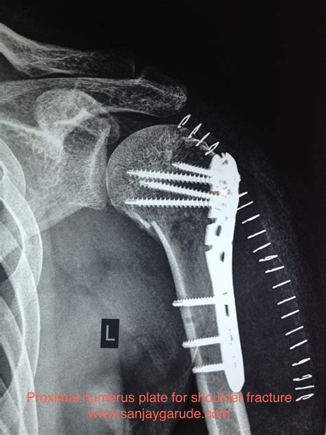 shoulder fractures dr sanjay garude 34440 hot sex picture