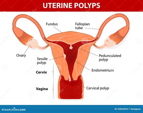 Cervical Polyps Uterus With Cervix Marked With Lines Small And Large Polyps Are Shown In