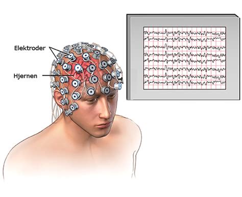 Diagnosticering Epilepsiforeningen