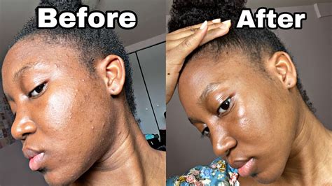 How I Cleared My Skin Naturally At Home 3 Acne And Dark Spot