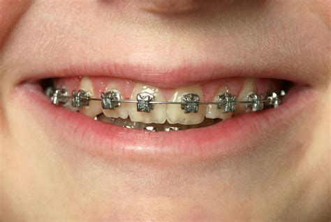 Patient Stuck In Braces For 11 Years Sues Orthodontist Redorbit