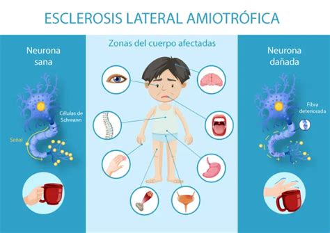 todo sobre el ela esclerosis lateral amiotrófica valida