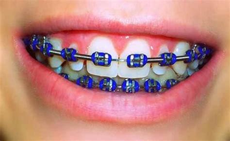 10 Steps On Choosing What Color Braces Should I Get Cute Braces Colors Cute Braces Braces Colors