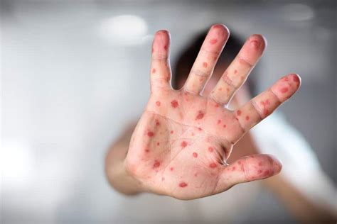 Hand Foot Mouth Disease What You Need To Know Béabausa