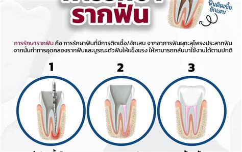 ตอบทุกข้อสงสัย การรักษารากฟัน Casa Dental Clinic