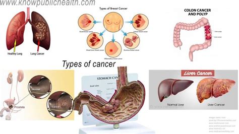 types of cancer breast cancer bladder cancer lung cancer