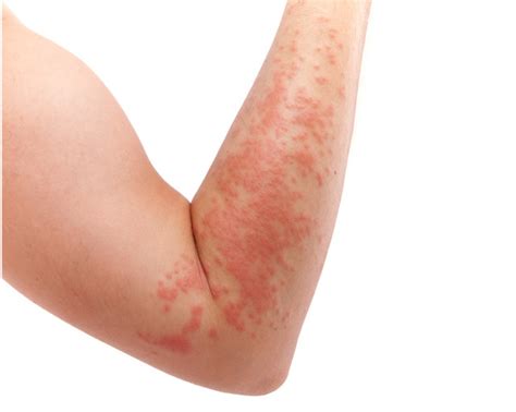 Skin Rashes Are A Sign Of Covid And Nhs Needs To Add Them To Official