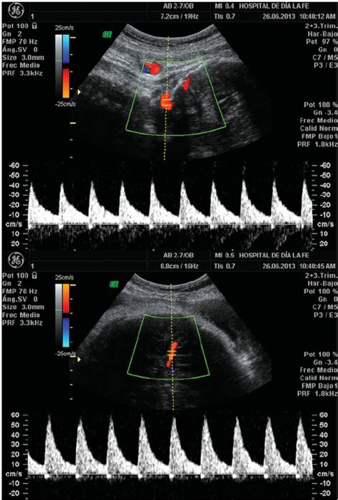 Color Doppler Ultrasound Examination Of The Vertebral Upper Picture