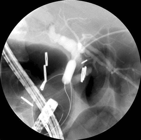 Percutaneous Balloon Dilation And Placement Of Endoscopic Biliary Stent
