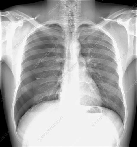 One of the schools that seems to have a great program is florida hospital of health sciences. Pneumothorax, X-ray - Stock Image - M240/0661 - Science Photo Library
