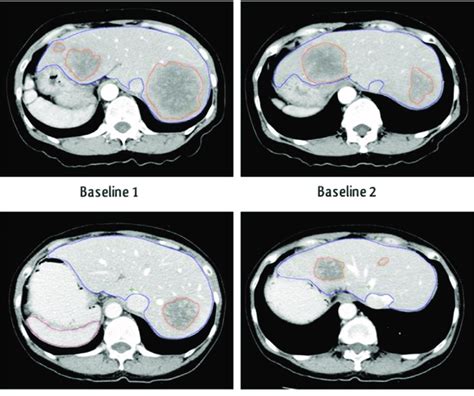 A Patient With Several Metastatic Liver Nodules On Different Slices At
