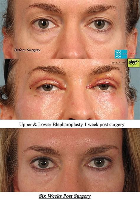 Types Of Eyelid Surgery And The Essential Checklist For Getting It Done