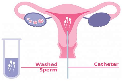 Intrauterine Insemination Iui Uses Risks And Success Rate