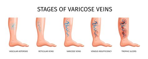 Etapas De Venas Varicosas Así Como Asteriscos Vasculares Venas Reticulares Insuficiencia Venosa