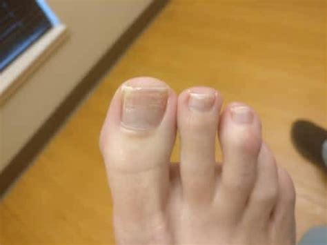 Foot Psoriasis And Toenail Psoriasis Home Remedies And Treatment