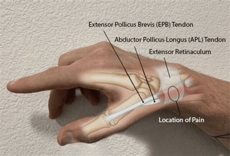 Thumb Sided Wrist Pain In Climbers A Case For De Quervains