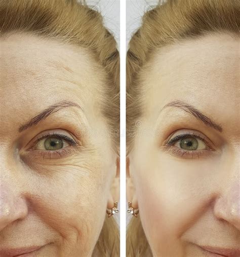 Face Wrinkle Woman Before And After Correction Stock Image Image Of