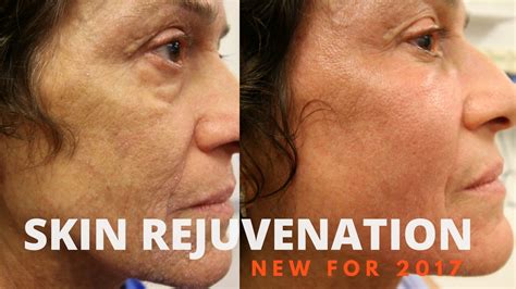 Skin Rejuvenation Before And Afters Youtube