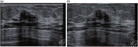 Posterior Acoustic Shadowing Breast Ultrasound Clinical Significance