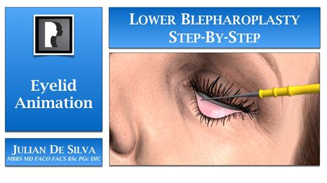 Blepharoplasty Animation How Is Lower Blepharoplasty Eyelid Surgery