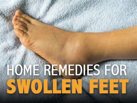 12 Effective Home Remedies For Swollen Feet