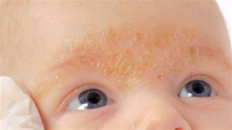 Your Full Guide To Deal With Seborrheic Dermatitis All Causes And
