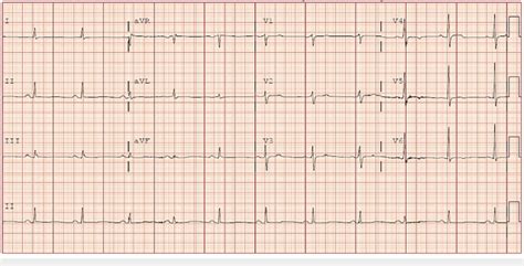 Ekg Demonstrating Diffuse T Wave Flattening And T Wave Inversions In V4