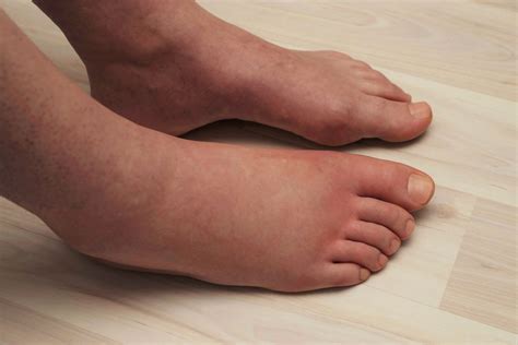Dry Feet Causes Discount Shop Save 51 Jlcatjgobmx