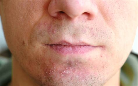 Skin Irritation After Shaving On Man`s Skin Closeup Nose And Lips